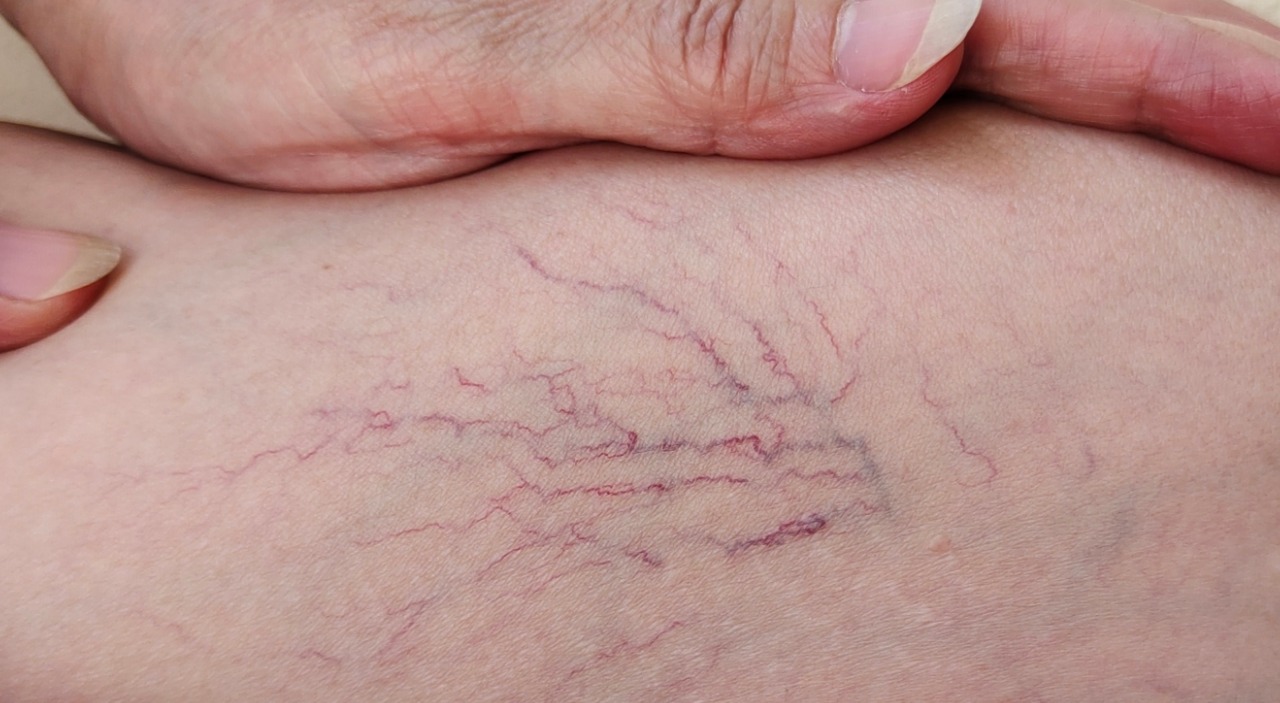 Spider Vein Removal